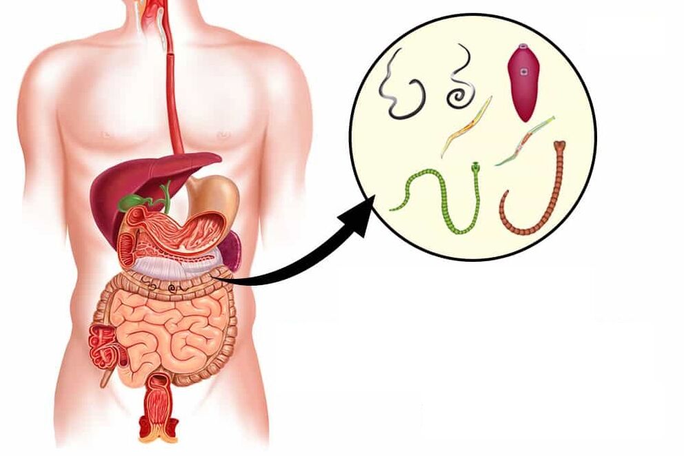 Verschillende wormen die in het menselijk lichaam leven